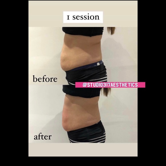 Cryosculpting Machine - Picture 11 of 12